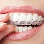 Straighten Your Teeth With Invisible Aligners